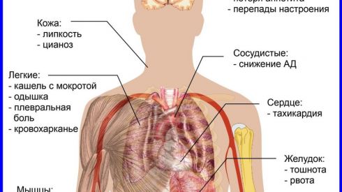 Скрытая пневмония: опасные симптомы