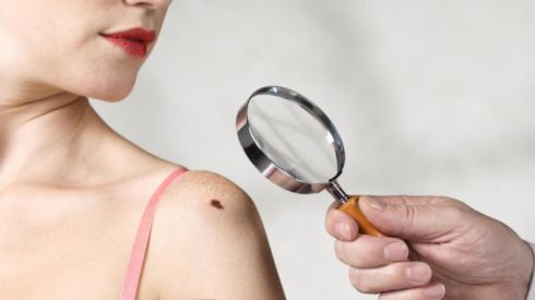 Видаляємо родимки грамотно і без наслідків