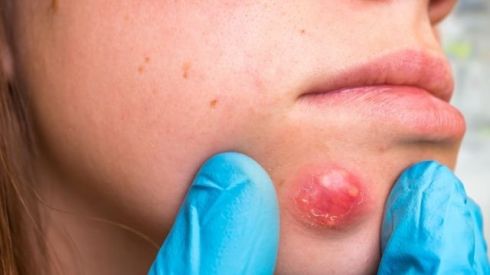 Що таке фурункул і карбункул?