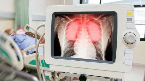 УЗИ или рентген: что лучше для диагностики пневмонии?