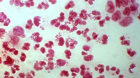 Поговоримо про уреаплазму.