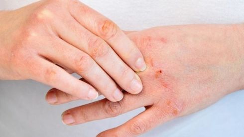 Відповідаємо на часті питання про псоріаз