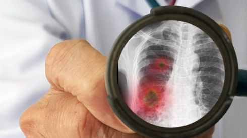 Как быстро восстановиться после ковидной пневмонии: 7 советов от пульмонолога