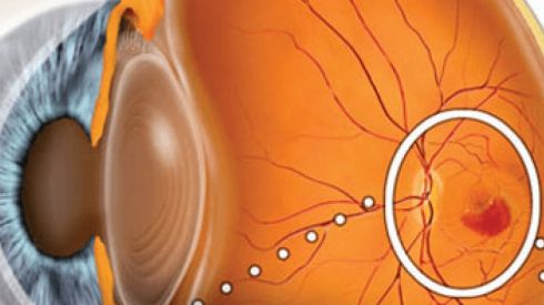 Успешный опыт лечения макулярной дистрофии сетчатки