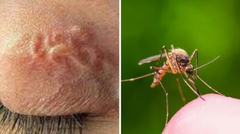 Комары заражают гельминтами: будьте осторожны