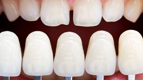 Вініри: навіщо вони потрібні і чи варто їх ставити?