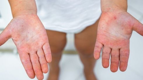 Скарлатина: симптоми, лікування, профілактика