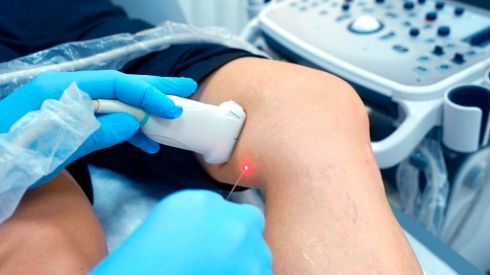 Сучасні методи лікування варикозу