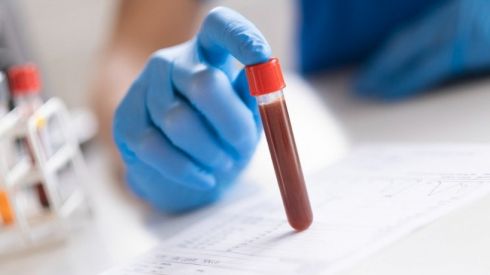Що таке коагулограма і що показує цей аналіз