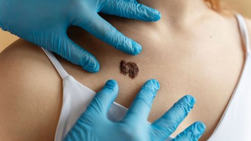 Першу в світі персоналізовану вакцину проти раку шкіри створили у Великобританії