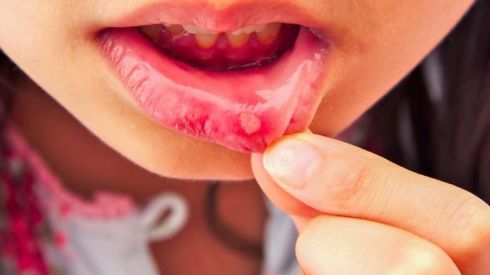 Чим лікувати стоматит: аптечні і народні засоби