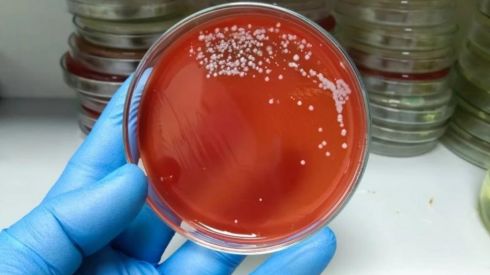 «М’ясоїдна бактерія»: світом шириться смертельна хвороба