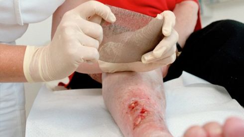 Венозні трофічні виразки: симптоми та лікування