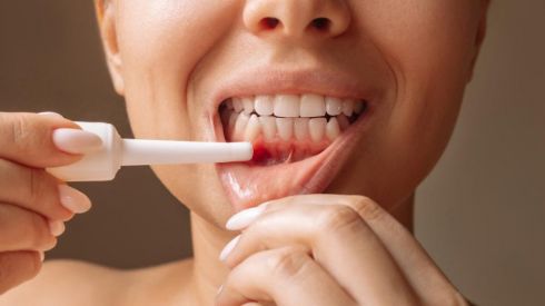 Виразки в роті: причини і лікування