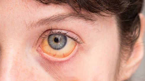 Спалах вірусного гепатиту А на Прикарпатті