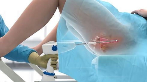 Эрозия шейки матки: чем она опасна?