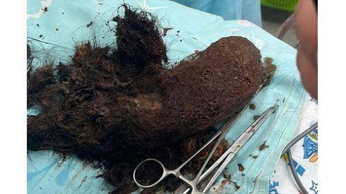 Кілограм волосся у шлунку: дівчину врятували львівські лікарі