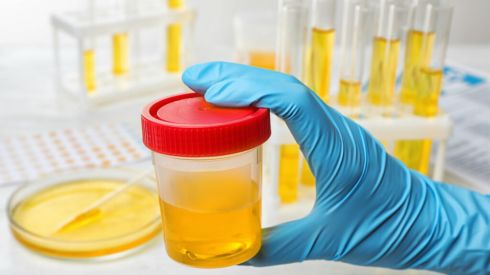 Оксалати в сечі: що це, чому з’являються і як лікуватися