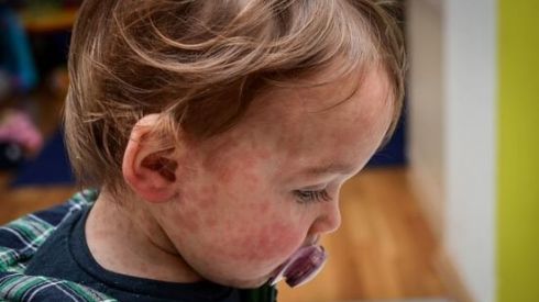 В Европе – опасные вспышки кори