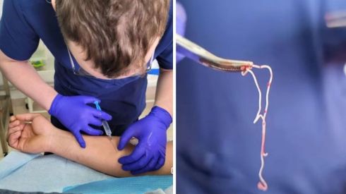 У львів’янина з ноги видалили паразита довжиною 11 сантиметрів