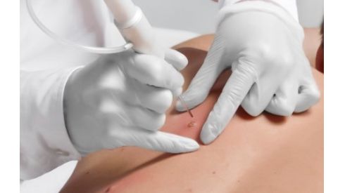 Что такое атерома и почему она возникает