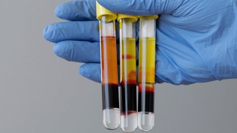 Що показує аналіз на гематокрит?