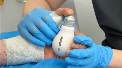 Українському військовому відновили руку за допомогою пальця ноги