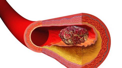 Топ-6 препаратів для розрідження крові, які найчастіше призначають лікарі