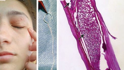 Жінка жила з 11-сантиметровим червом в оці і не підозрювала про це
