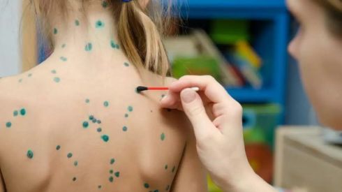 Вітрянка повертається: в Україні фіксують зростання захворюваності
