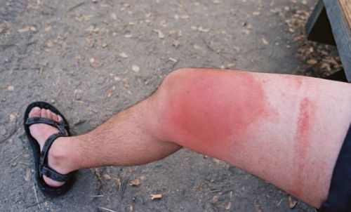 Укус шершня