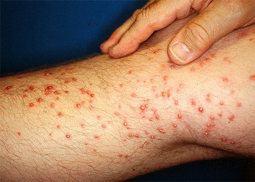 Укусы муравьев