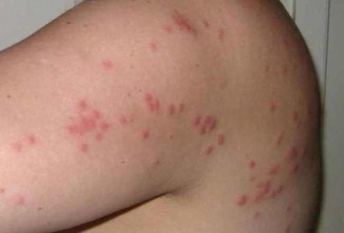 Укусы клопов