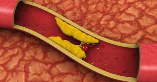 Атеросклероз - основная причина образования тромбов