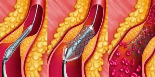 Стентирование