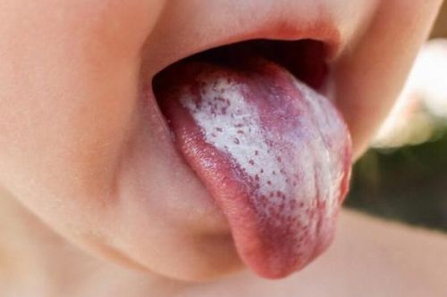 Молочный налет у грудничка