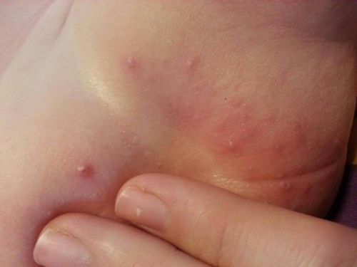 Потница у малыша