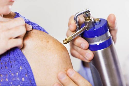 Криодеструкция веснушек на плече