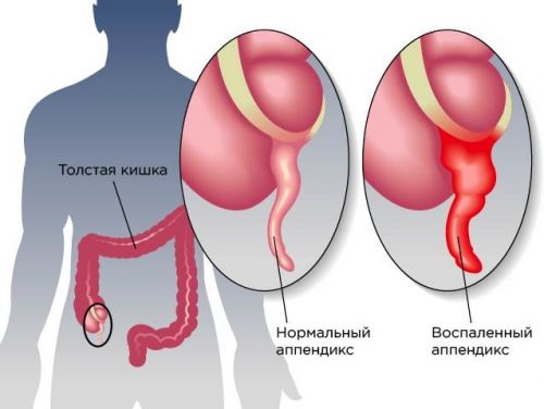 Типичная локализация аппендикса