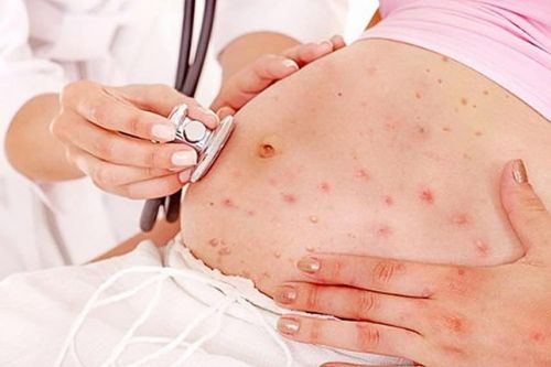 Ветрянка на 6-9 месяце беременности неопасна для плода