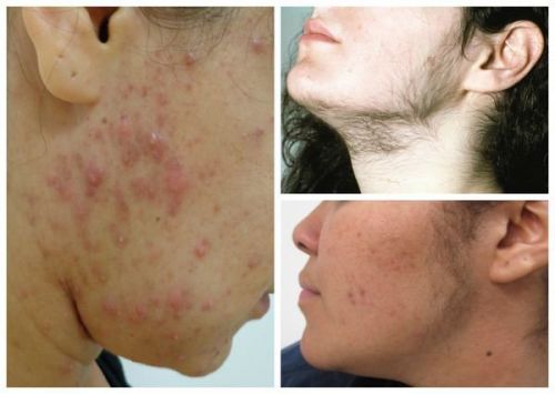 Повышенное оволосение и акне - одни из симптомов поликистоза