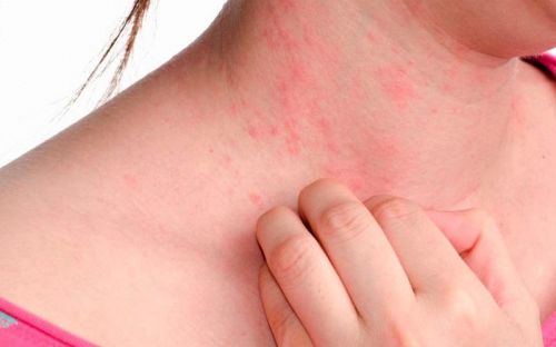 Лекарственная крапивница