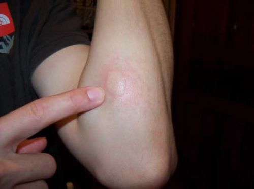 Уплотнение после укуса комара - гельминт под кожей