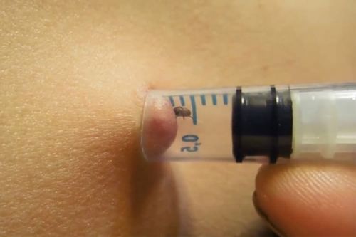 Витягування кліща шприцем